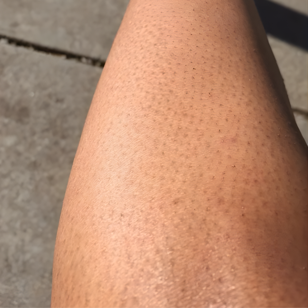 How to Get Rid of Strawberry Skin Naturally